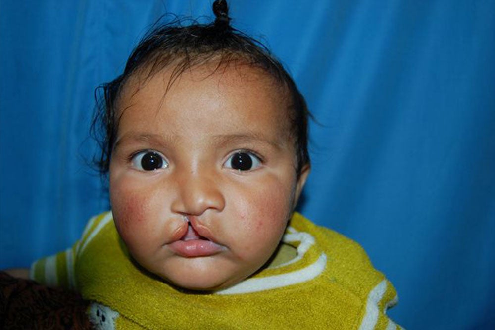Anmolpreet bébé avant sa chirurgie de la fente
