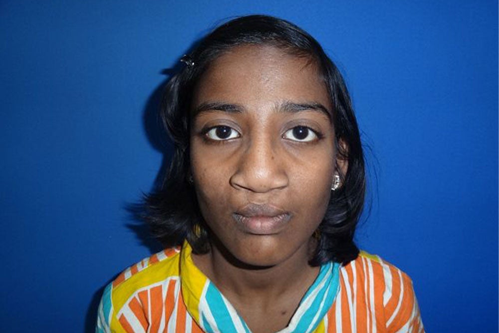 Dre Mayuri Kalyanpad avant sa chirurgie de la fente parrainée par Smile Tain