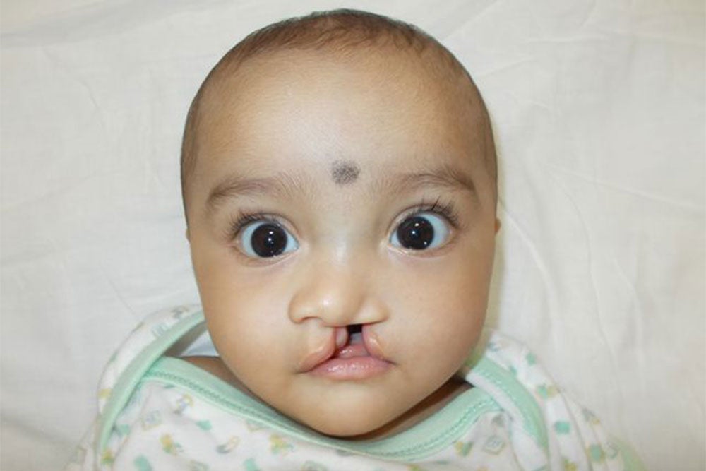 Durva as a baby, before cleft surgery