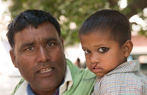 Enfant avec une fente et son père