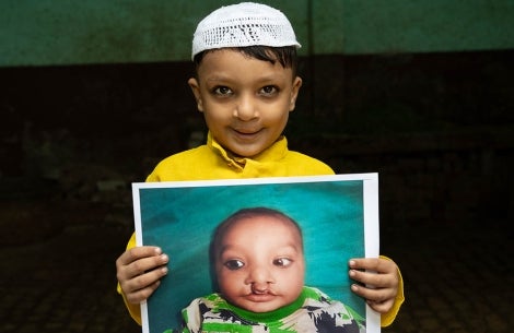 Boy hold image of himself before cleft lip surgery