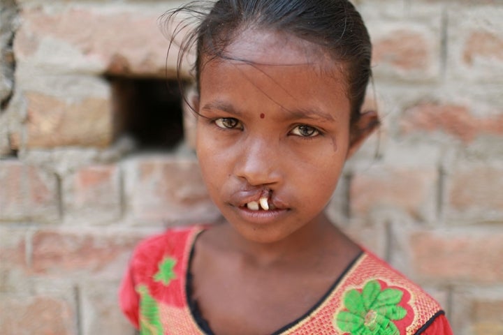 Fille avec une fente labiale non traitée