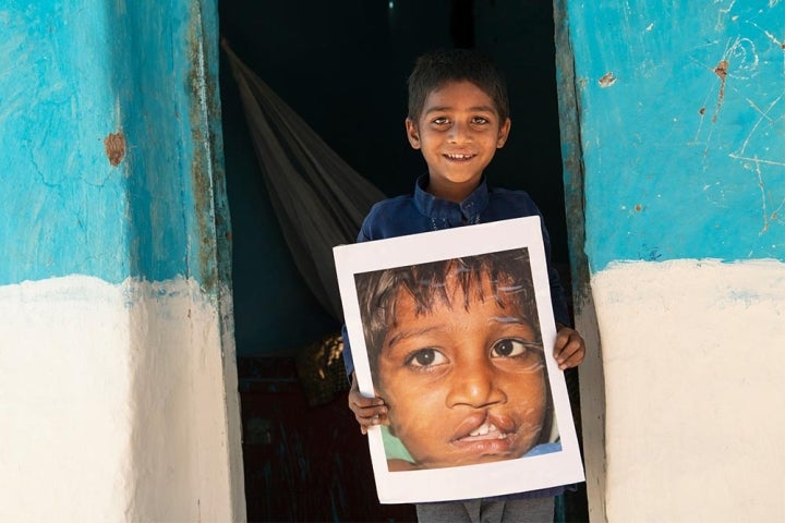 Bo holding a picture before cleft lip surgery