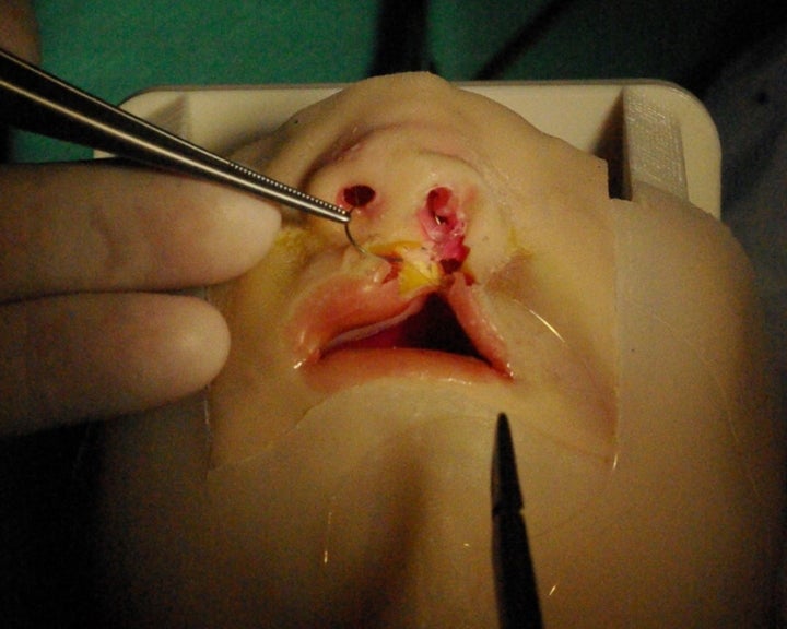 chirurgie de la fente simulée
