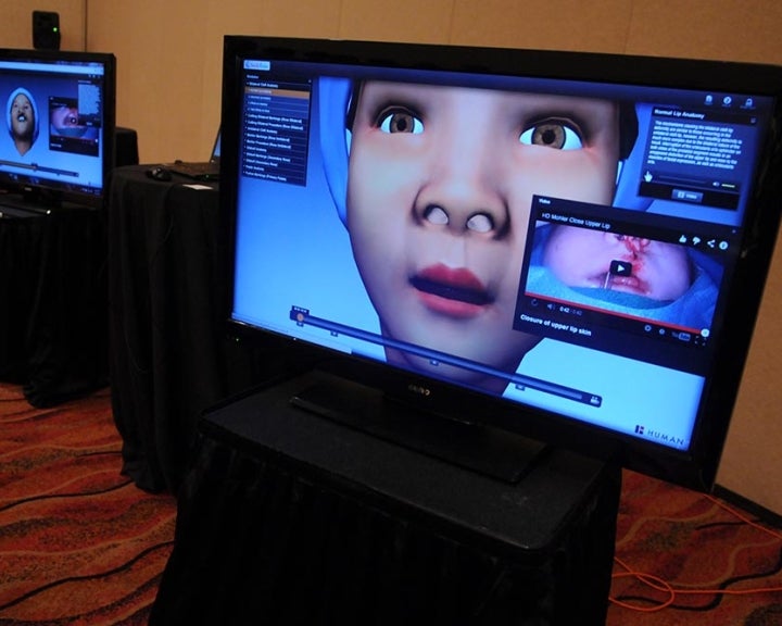Programme de simulation de chirurgie virtuelle Smile Train