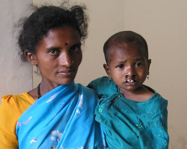 Mother holding her child with untreated cleft lip