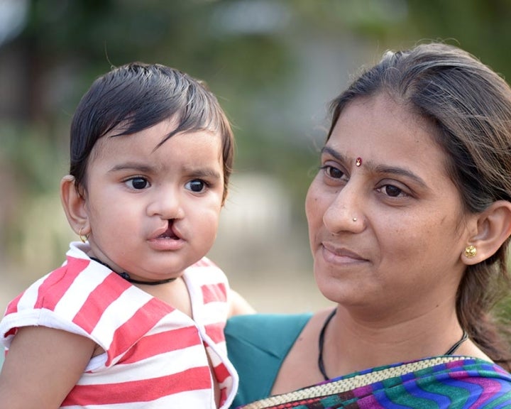 Mother carrying her child with a cleft