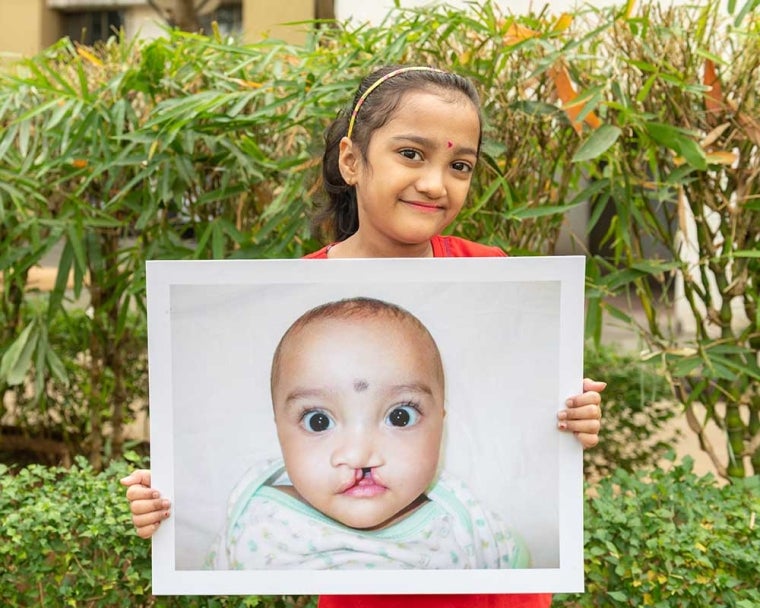 Une jeune fille montre une image d'elle avant une chirurgie de la fente labiale