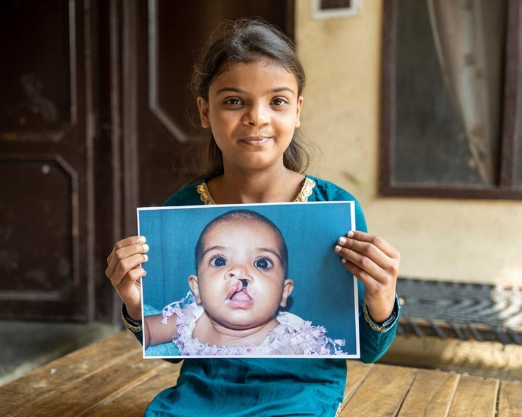 Une jeune fille montre une image d'elle avant une chirurgie de la fente labiale